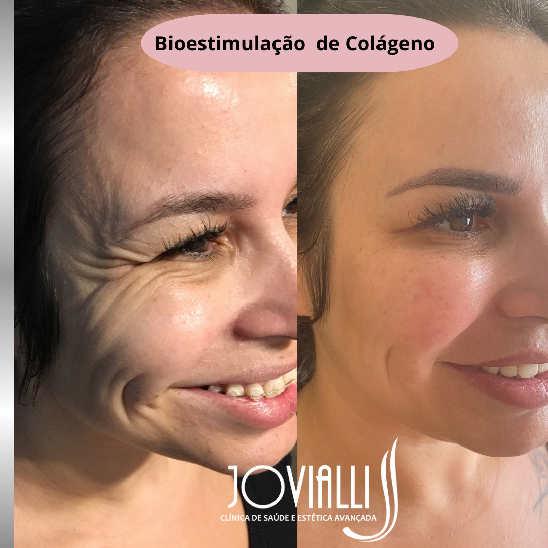 Bioestimulacao de Colágeno.png