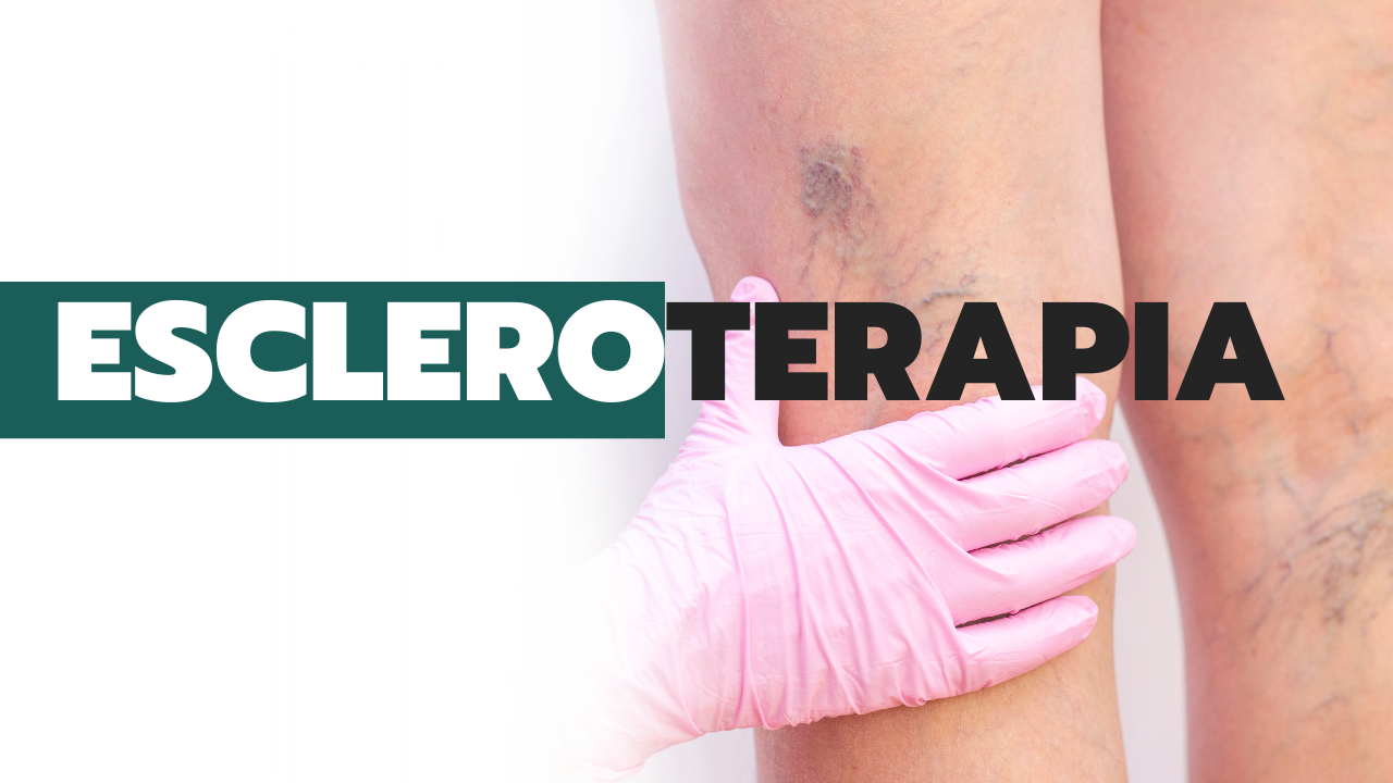 Procedimento Escleroterapia