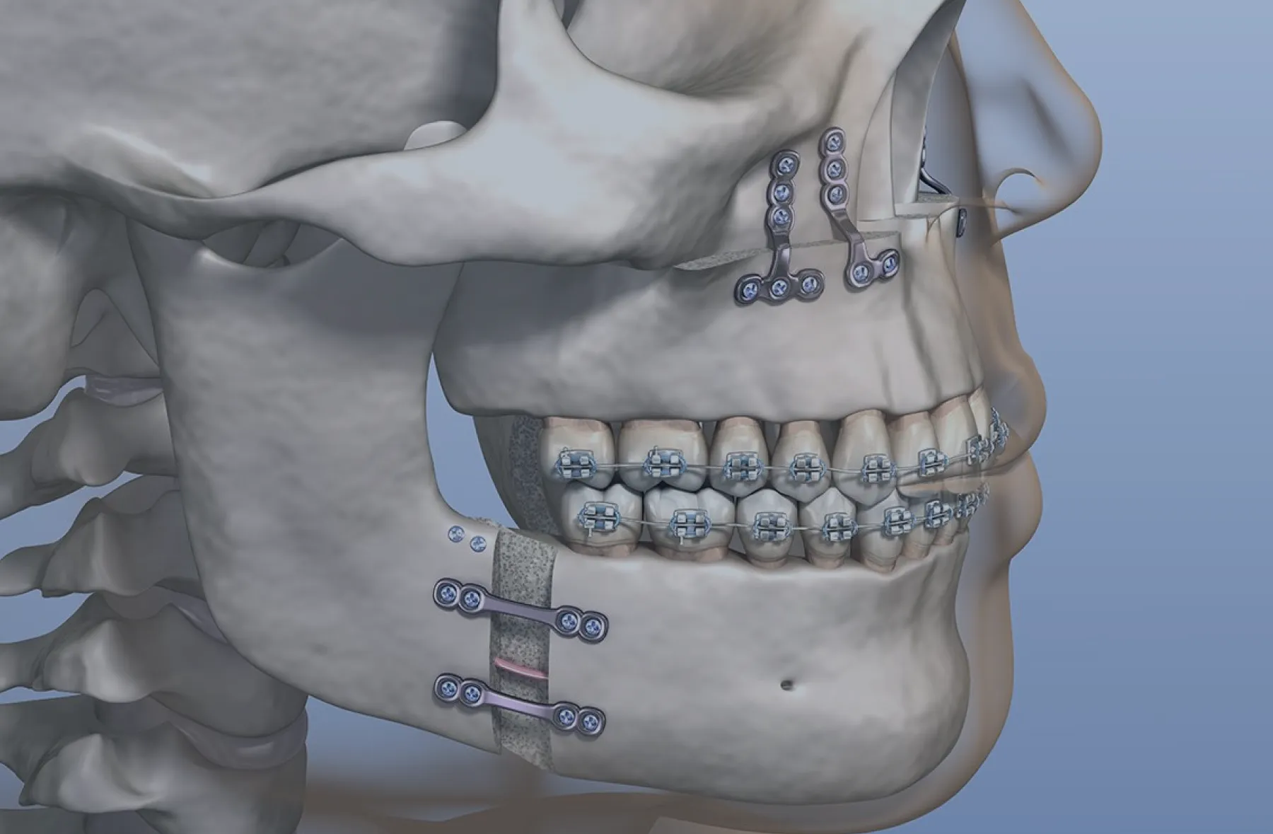 Bucomaxilofacial