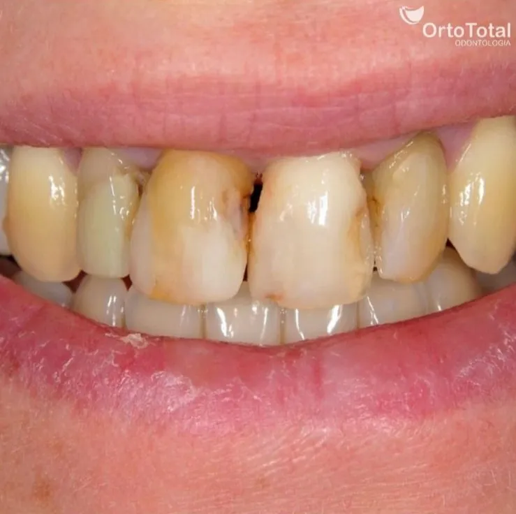 Antes da Prótese Dentária