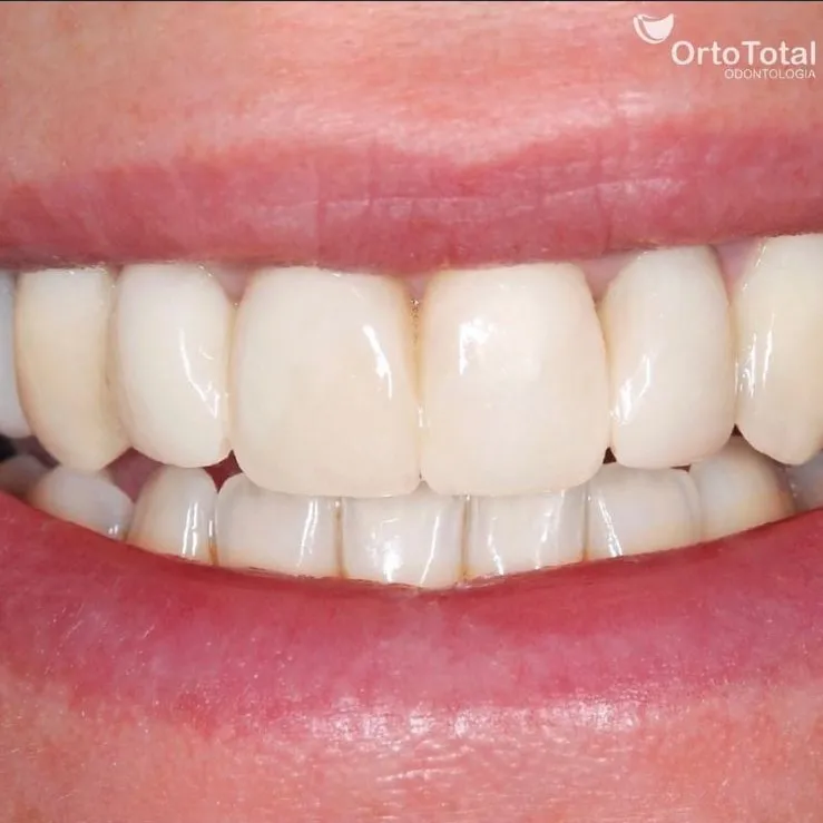 Depois da Prótese Dentária