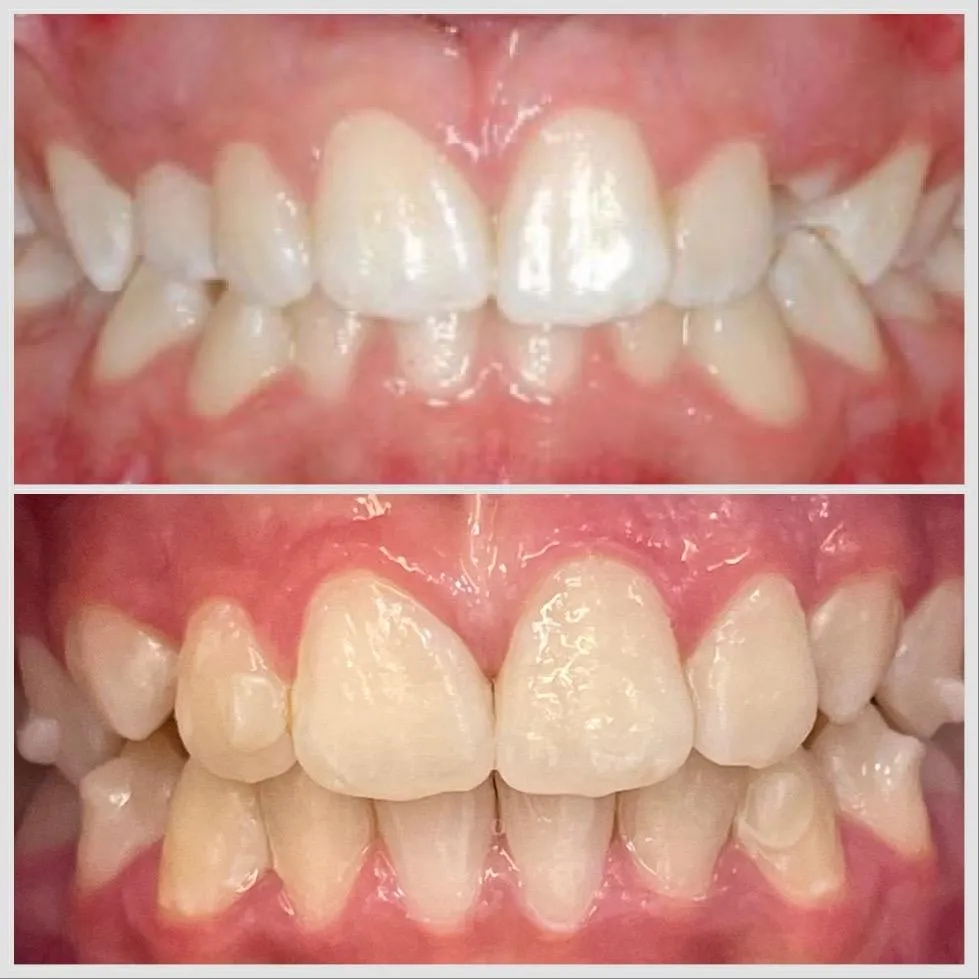 antes e depois AV_11zon